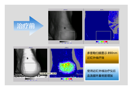 这个季节你要稍微警惕下糖尿病足