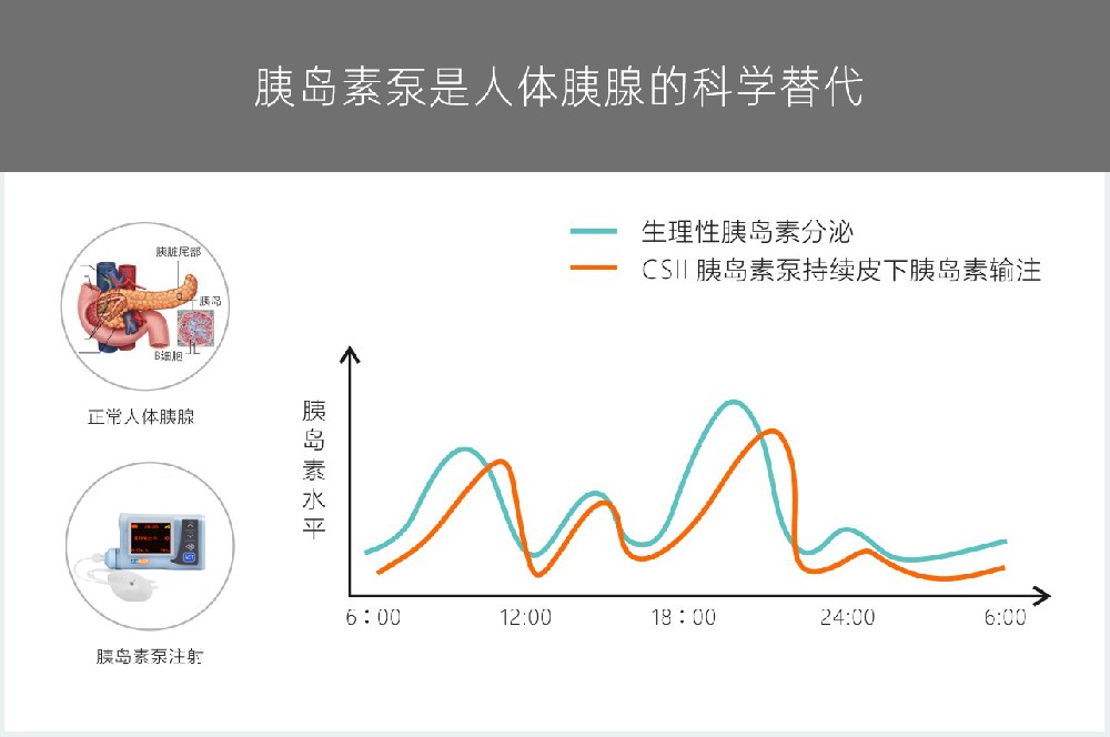 每日多次注射胰岛素效果不佳？研究表明胰岛素泵治疗或是不错的选择